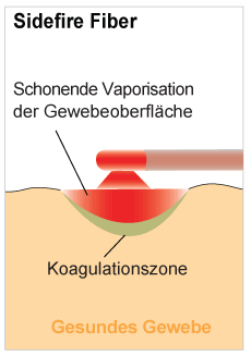applicator sidefire